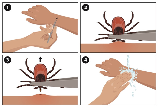 Tick removal infographic